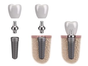 dental implants.