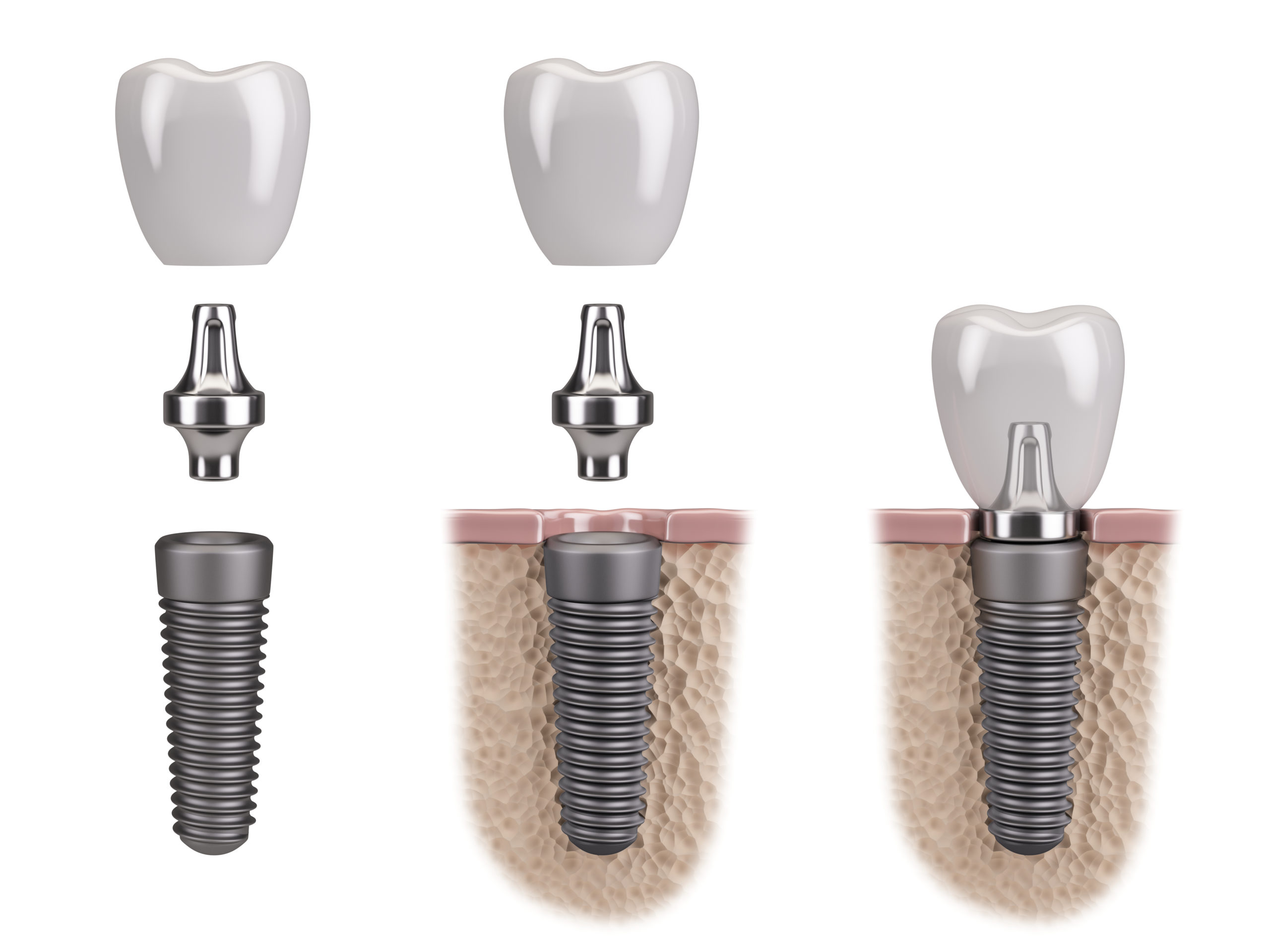 dental implants.