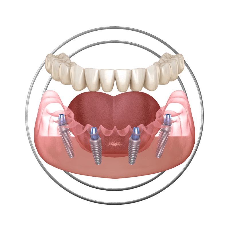 full arch stylized 3d1