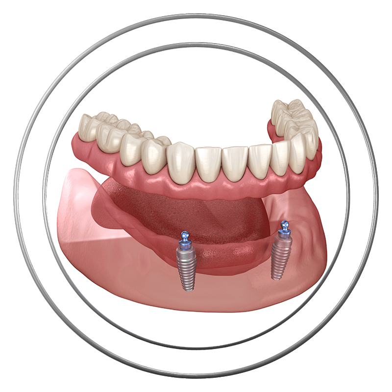 snap on denture 3d