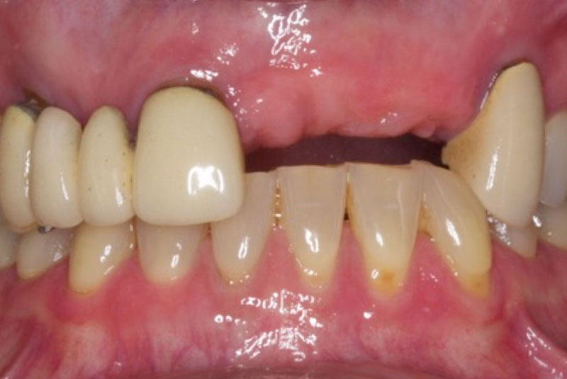 Crowns-5E-max-before