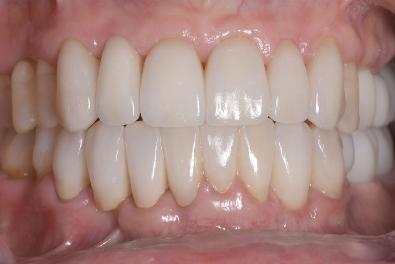 after-veneer-689