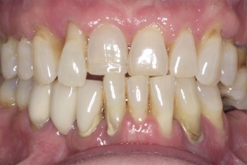 before-veneer-689