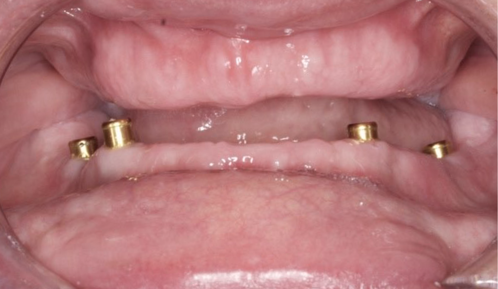 All on 6 for both arches Implants (#3,4,6,11,13,14,18,21,22,27,28,31)