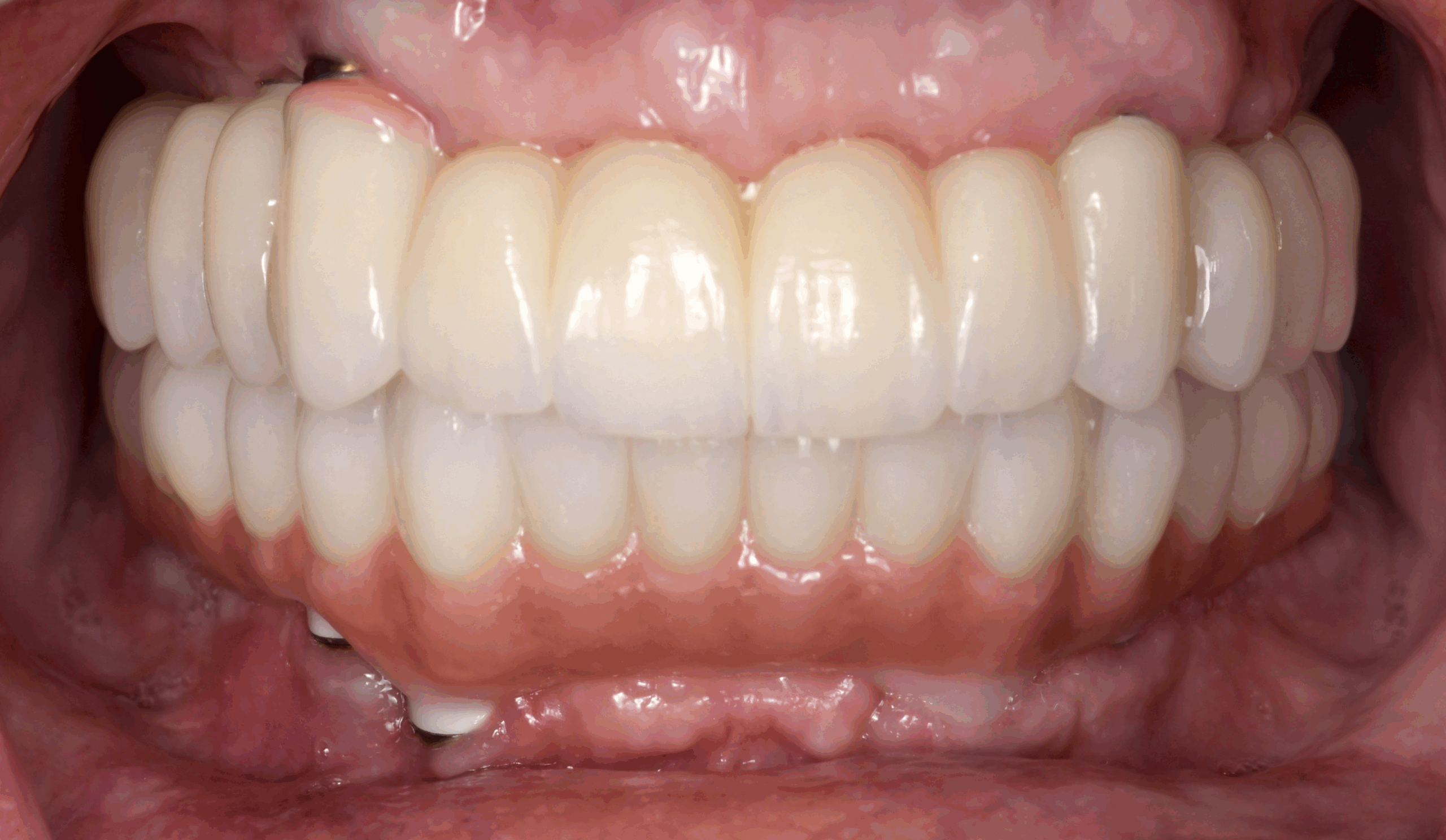 All on 6 for both arches Implants (#3,4,6,11,13,14,18,21,22,27,28,31)