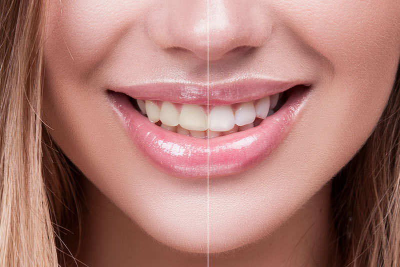Before and after results of professional teeth whitening at J.P Prosthodontics in Fullerton, CA